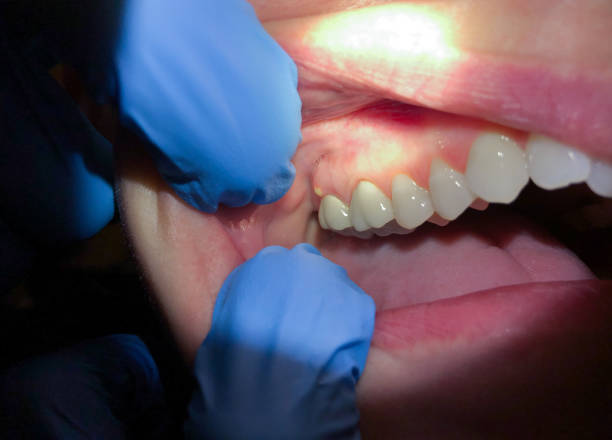 Best Tooth Infection Emergency Dentist  in Crestline, OH
